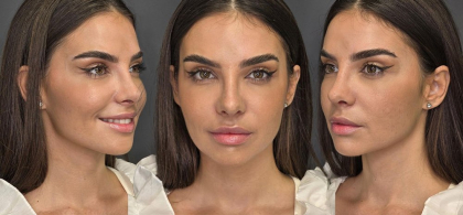 Mellina și-a operat nasul! Artista e super fericită la zece zile de la intervenția estetică de rinoplastie: „Mi-am făcut toate mofturile sufletului meu anul asta!”