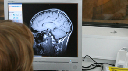 NRTI, medicamentele anti-HIV care ar putea preveni un milion de cazuri de Alzheimer anual