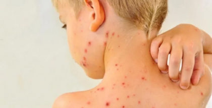 O boală considerată eradicată face ravagii în SUA, după scăderea vaccinării. Kennedy Jr., în centrul scandalului