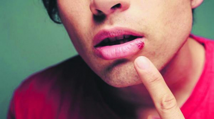 Cum tratezi un herpes cu ingrediente naturale: 5 remedii casnice eficiente