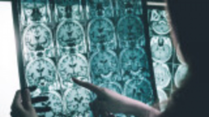 Test revoluționar aprobat în SUA. Alzheimerul poate fi detectat printr-o simplă analiză de sânge
