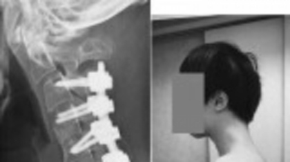 Cum i-au afectat orele petrecute în exces pe telefon sănătatea unui tânăr. Medicii trag un semnal de alarmă