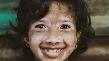 Tratament pentru vitiligo care îți îmbunătățește vizibil aspectul pielii și îți echilibrează sistemul imunitar