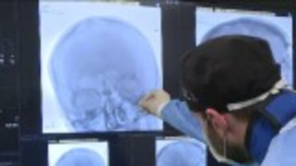 Pastila care triplează riscul de accident vascular cerebral subit la femeile tinere. Ultimele studii prezentate la Helsinki