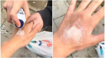 Nou pericol pe TikTok. Adolescenți mutilați pe viață după ce au răspuns la provocarea deodorantului