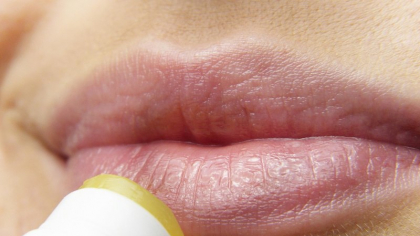 Tinctura care te scapă de herpes într-o singură zi. Conține o plantă cu multe beneficii