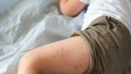 Cel puțin 49 de cazuri de rujeolă au fost înregistrate în septembrie. Vaccinările ROR continuă în întreaga țară