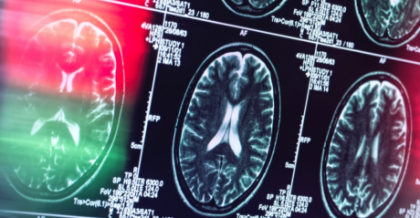 Veste uriașă despre boala Alzheimer, considerată timp de decenii o cale fără întoarcere