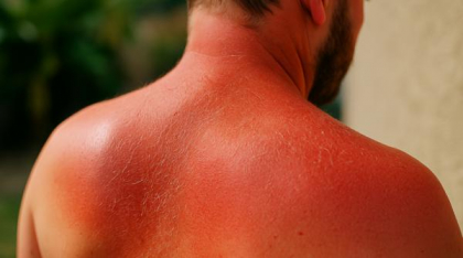 Piele arsă de soare? Iată cele mai bune remedii naturale