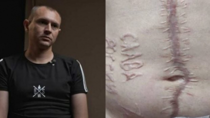 Andrei, soldatul care a fost ars pe abdomen cu inscripția „Glorie Rusiei”: „E opera unui sadic chirurg rus. Ca să nu uit unde am fost”