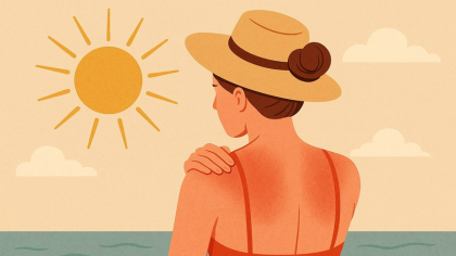 Arsura solară: Poarta de intrare către cancerul de piele? Adevărul prezentat de dermatologi