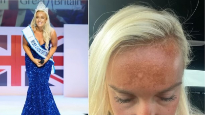 Trendul viral care îți crește riscul de cancer de piele: bronzarea nazală. Avertismentul dermatologilor