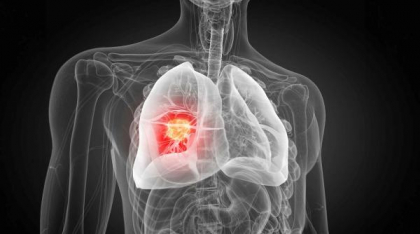 Poluarea aerului, asociată cu mutațiile ADN generatoare de cancer pulmonar